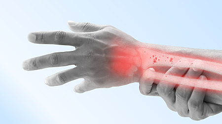 Osteoporoza - częsta przyczyna złamań